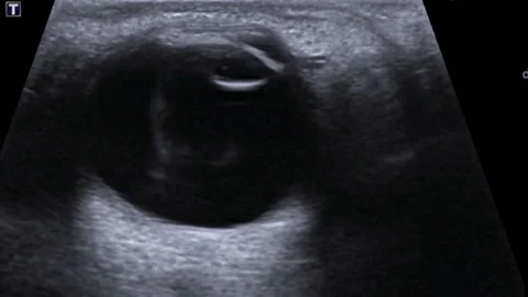 Detached retina, ultrasound scan Stock Footage