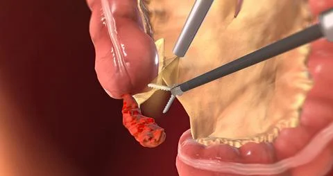 Detaching the Mesentery 3D rendering Stock Illustration
