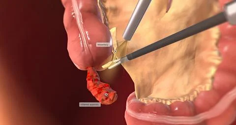 Detaching the Mesentery 3D rendering Stock Illustration