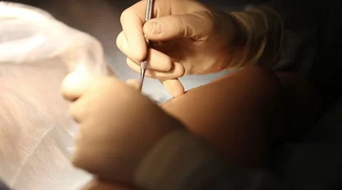 Detail of a surgery Stock Footage 67523449
