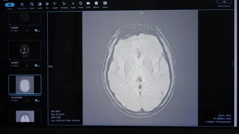 Detailed brain scans made with advanced MRI software displayed on the computer Stock Footage 321411124