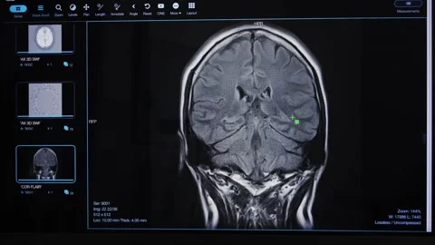 Detailed brain scans made with advanced MRI software displayed on the computer Stock Footage 327383479