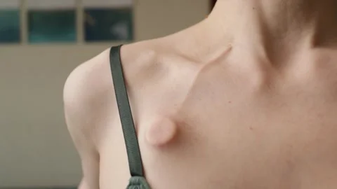 Detailed close view of an implanted chemo port and small scar on the upper .. Video stock 335632452