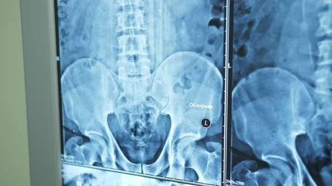 Detailed close-up on X-rays of the spine and pelvis. Stock Footage 146192863