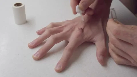 Detailed demonstration of applying topical solution to treat wart on hand Stock Footage 330324343