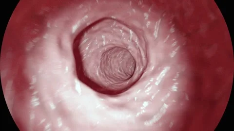 Detailed Endoscopy View of Human Colon Medical Procedure Highlighting Pink .. Stock-Footage 314068541