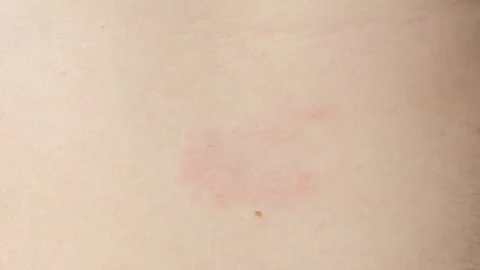 Detailed macro shot of dermatitis spots and redness on sensitive skin Stock-Footage 337349085