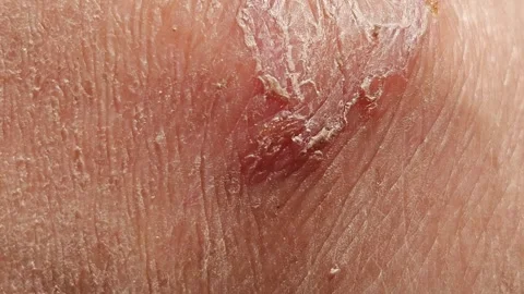 Detailed Macro View Of Rough Dry Flaking Human Skin With Severe Cracking 스톡 동영상 346952609