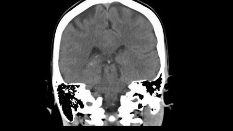 Detailed MRI Scan of the Human Brain Displaying Distinctive Gray and White Stock Footage 316624504