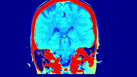 Detailed MRI Scan of the Human Brain Displaying Distinct Regions in Vivid Colors Stock Footage 317528633