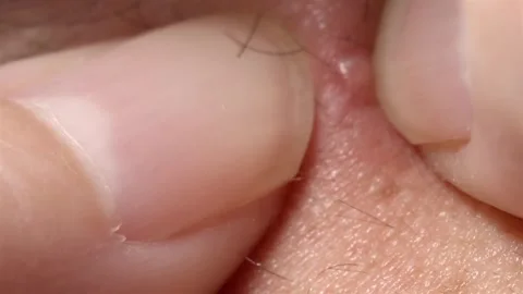 Detailed Video of Squeezing a White Pimple Zit with Fingers Close-Up 스톡 동영상 337148439
