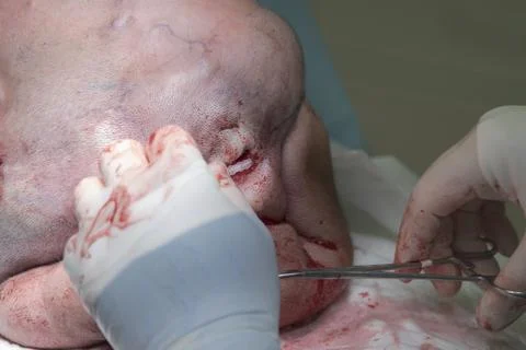 Details Of Tissue Expander During Setting Stockfoto's