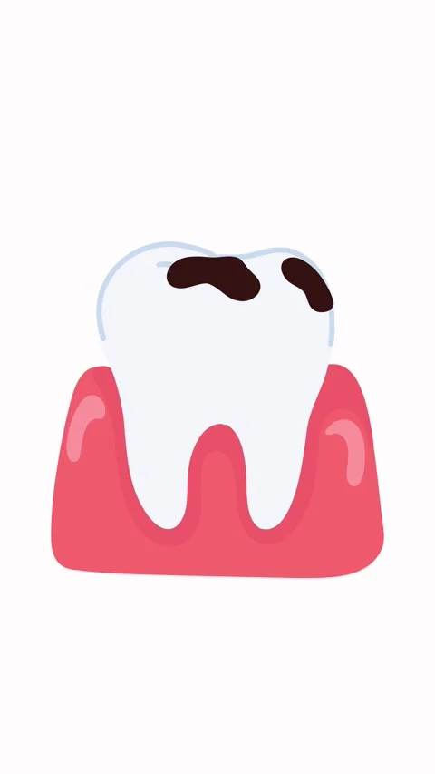 Developing tooth decay progression on enamel surface Stock Footage 336159858