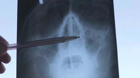 Deviated septum 스톡 동영상 295666896