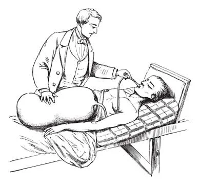 Device Limousin to administer the oxygen in cases of asphyxia by submersion, Stock Illustration