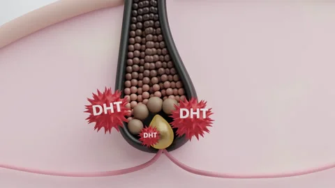DHT hormone attacking hair root causing hair loss and thinning Video stock 320591108