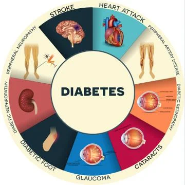 Diabetes complications Stock Illustration