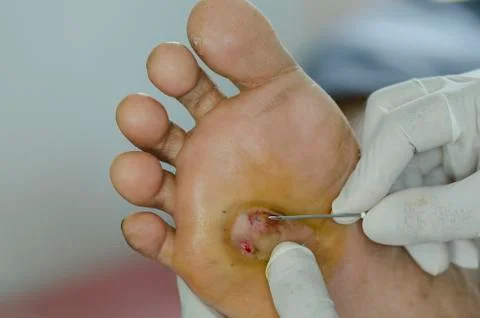 Diabetes foot wound. Stock Photos