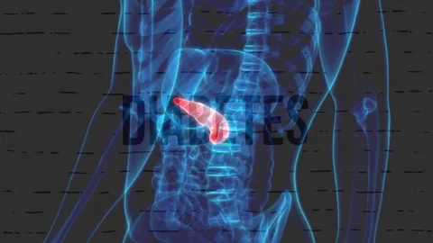 Diabetes Text Over 3D Blue Human Torso Highlighting Pancreas Stock Footage 337050566