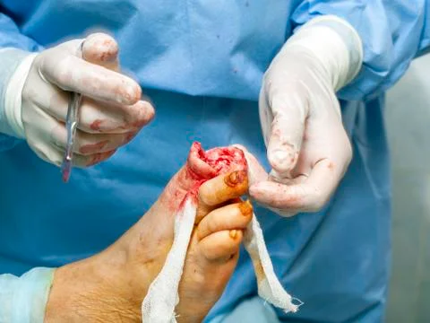 Diabetic foot syndrome. Gangrene of the big toe. Amputation of the big toe. Stock Photos