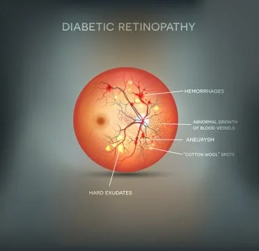 Diabetic retinopathy background. Stock Illustration