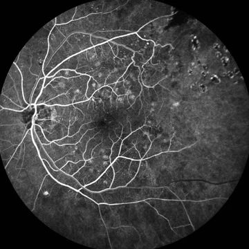 Diabetic Retinopathy Stock Footage 64801904