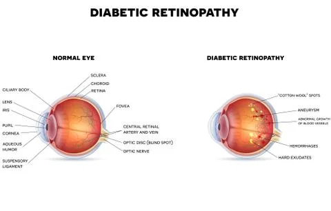 Diabetic retinopathy Stock Illustration
