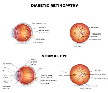 Diabetic retinopathy Stock Illustration