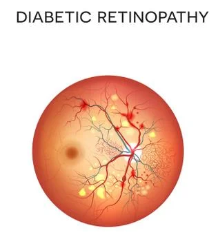 Diabetic retinopathy Stock Illustration