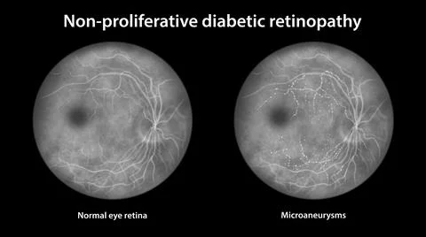 Diabetic retinopathy, ophthalmoscopic diagnosis, illustration Stock Illustration