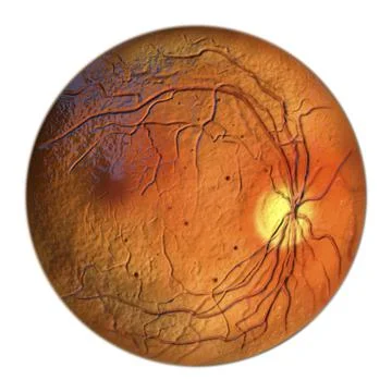 Diabetic retinopathy, ophthalmoscopic diagnosis, illustration Stock Illustration