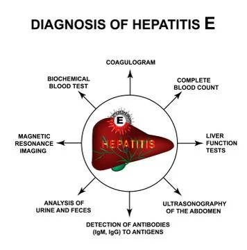 Diagnosis of hepatitis E. World Hepatitis Day. Infographics. Vector illustration Stock Illustration