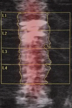 Diagnostic imaging of spinal bone density in an elderly woman with severe ost 库存照片