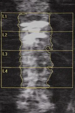Diagnostic imaging of spinal bone density in an elderly woman with severe ost 库存照片