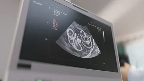 Diagnostic procedure detected twins inside of the pregnant womans belly Stock Footage 201414861