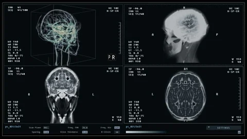 Diagnostic software thoroughly examining the damaged patients brain organ Vídeo Stock 201191334