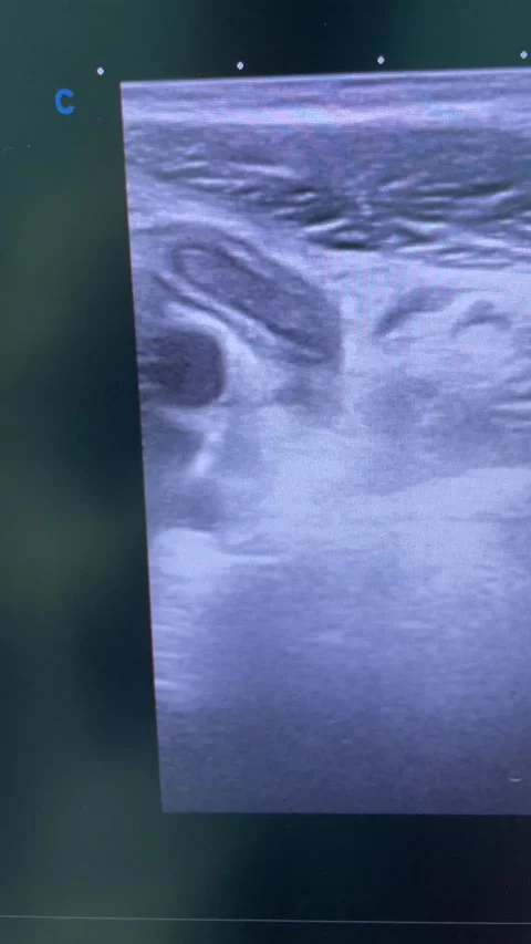 Diagnostic Sonogram of Inflamed Appendix - Appendicitis Case 1 Stock Footage 213032531