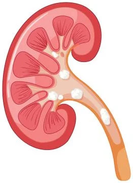 Diagram of kidney having problem Stock Illustration