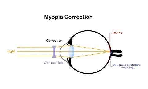 Diagram of myopia correction showing Stock Illustration