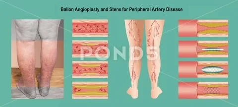 Diagram showing angioplasty for peripheral artery disease illustration ...