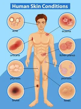 Diagram showing differen human skin conditions Stock Illustration