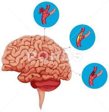 Diagram showing problems with brain ~ Clip Art #86303519