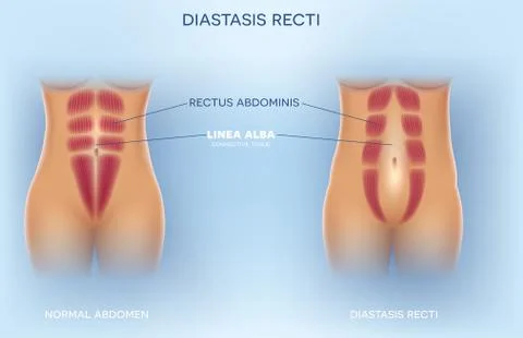 Diastasis Recti Stock Illustration