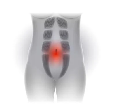 Diastasis Recti or abdominal separation Stock Illustration