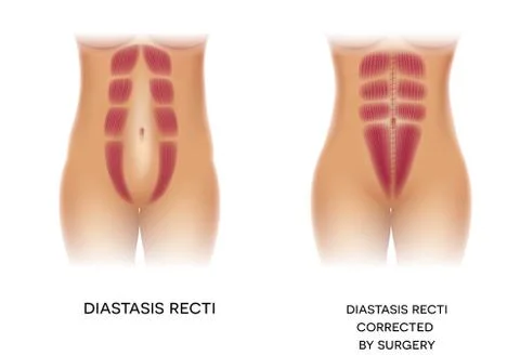 Diastasis Recti or abdominal separation repair Stock Illustration