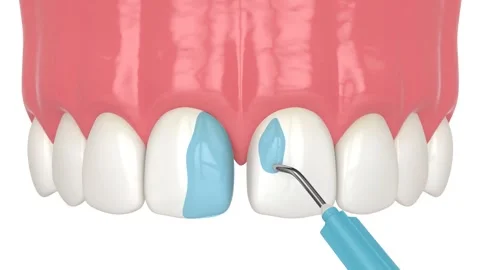 Diastema closure using bonding procedure Stock Footage 256220910