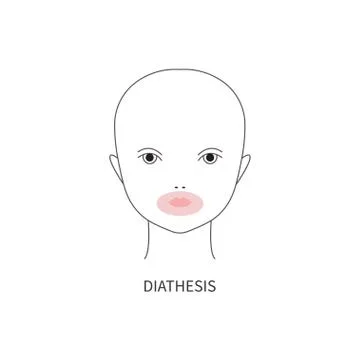 Diathesis in baby Stock Illustration