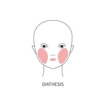 Diathesis in child Illustrazione stock