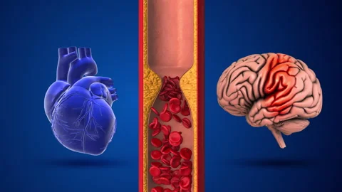 Difference between stroke and heart attack Stock Footage 256297440