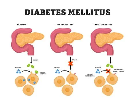 Difference between type one diabetes and type two diabetes, pancreas anatom.. Stock Illustration